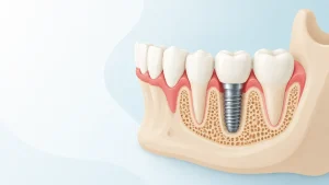 Ilustração em corte de um implante dentário integrado ao osso e sustentando uma coroa
